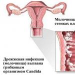 Молочница у беременных женщин: причины и лечение, народные средства, признаки Молочница у беременных чем лечить